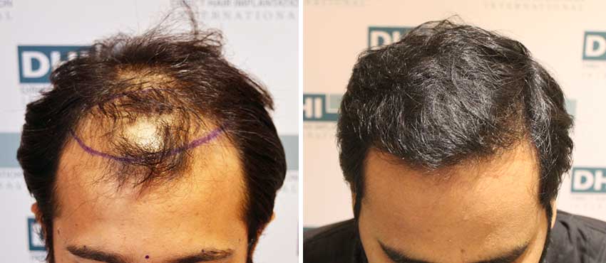 DHI before & after hair transplant results