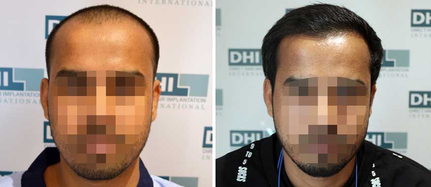 DHI before & after hair transplant results