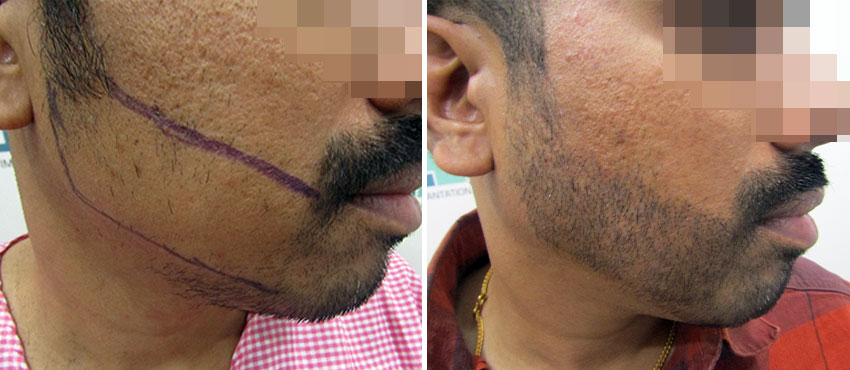  beard hair transplant results