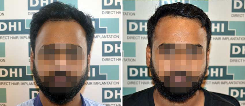 DHI before & after hair transplant results