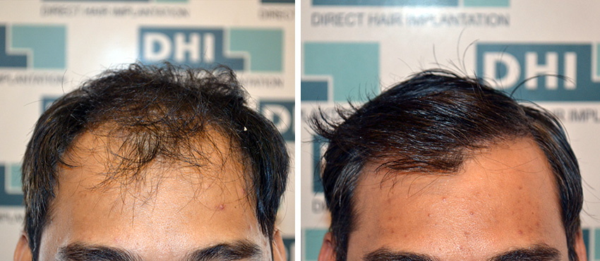 DHI before & after hair transplant results