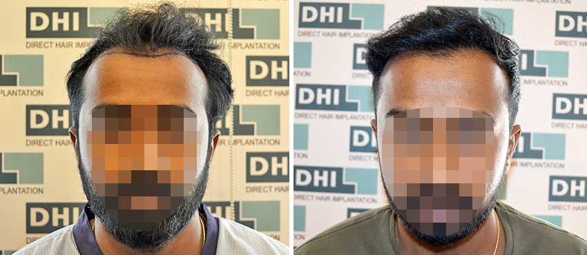 DHI before & after hair transplant results