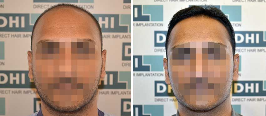 DHI before & after hair transplant results