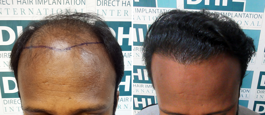 DHI before & after hair transplant results