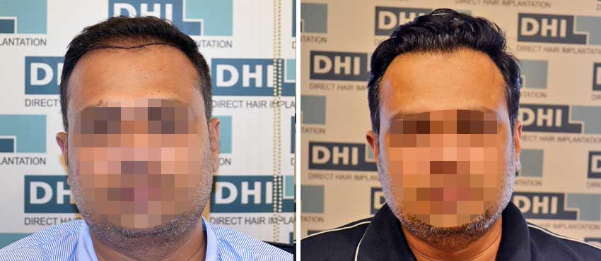 DHI before & after hair transplant results