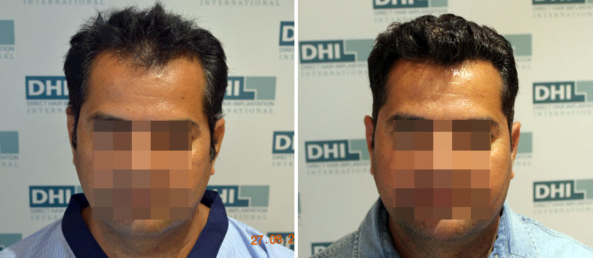 DHI before & after hair transplant results