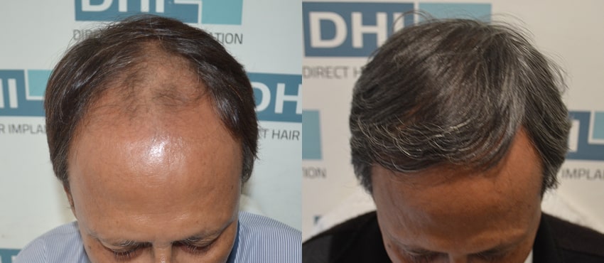 DHI before & after hair transplant results