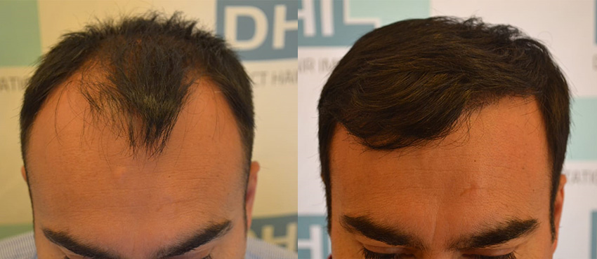 DHI before & after hair transplant results