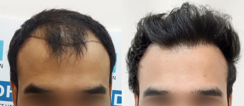 DHI before & after hair transplant results