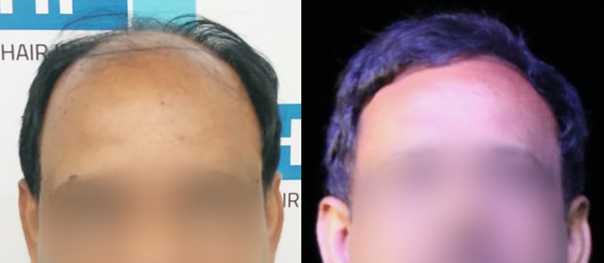 DHI before & after hair transplant results