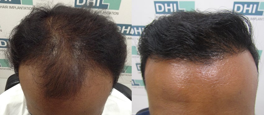 DHI before & after hair transplant results