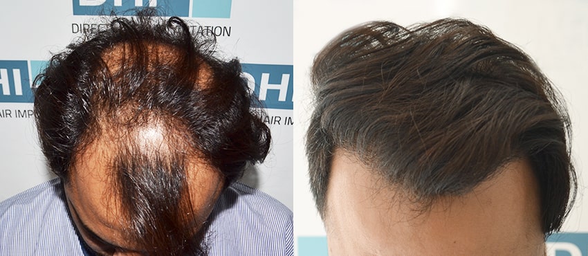DHI before & after hair transplant results
