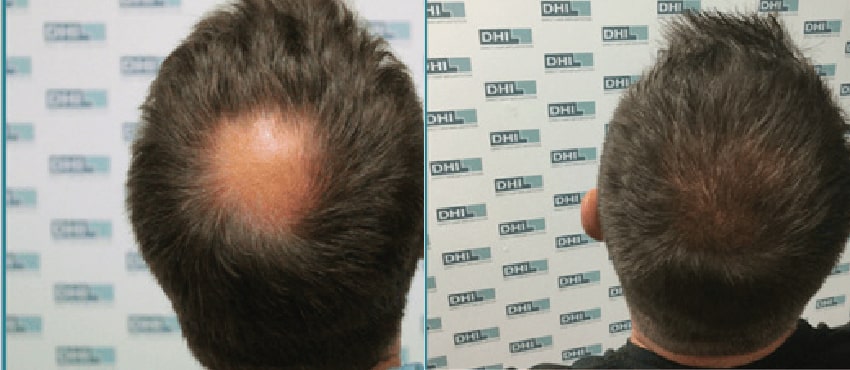 DHI before & after hair transplant results