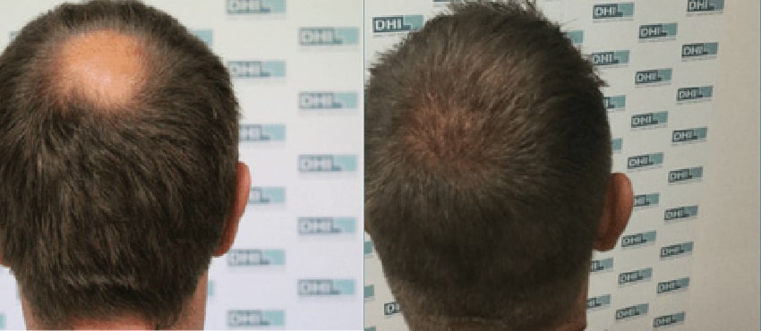 DHI before & after hair transplant results