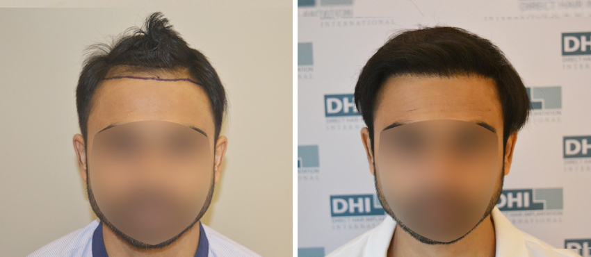 DHI before & after hair transplant results