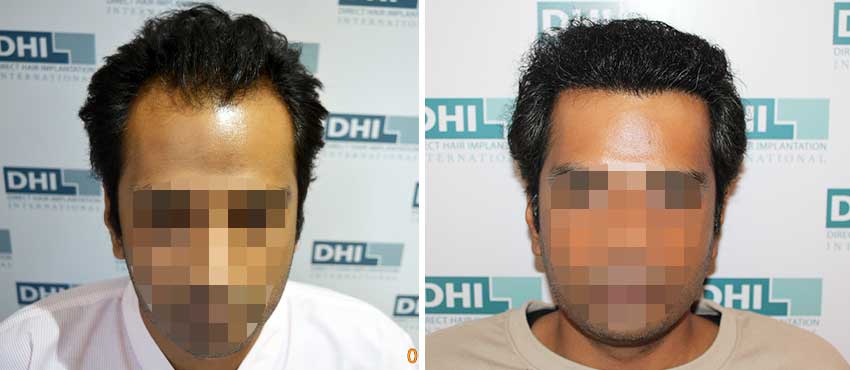 DHI before & after hair transplant results