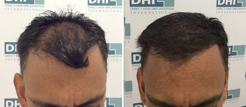 DHI before & after hair transplant results