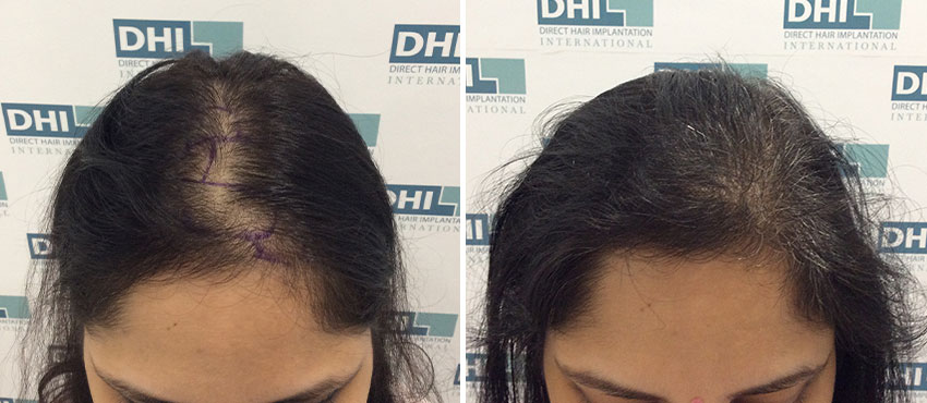 DHI before & after hair transplant results