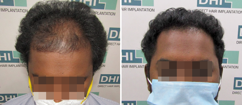 DHI before & after hair transplant results