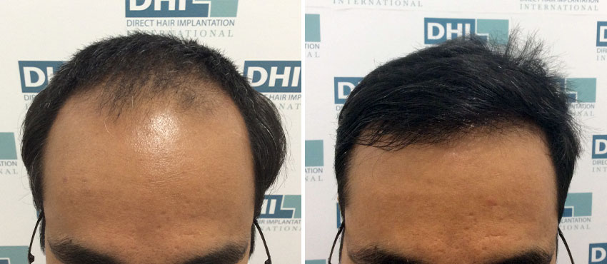 DHI before & after hair transplant results