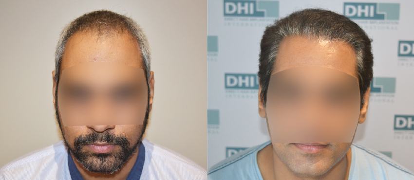 DHI before & after hair transplant results