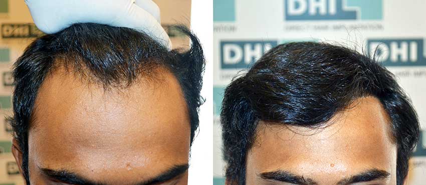 DHI before & after hair transplant results