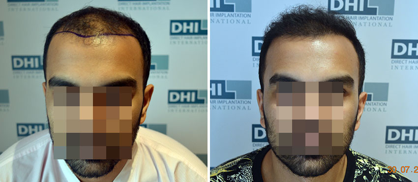 DHI before & after hair transplant results