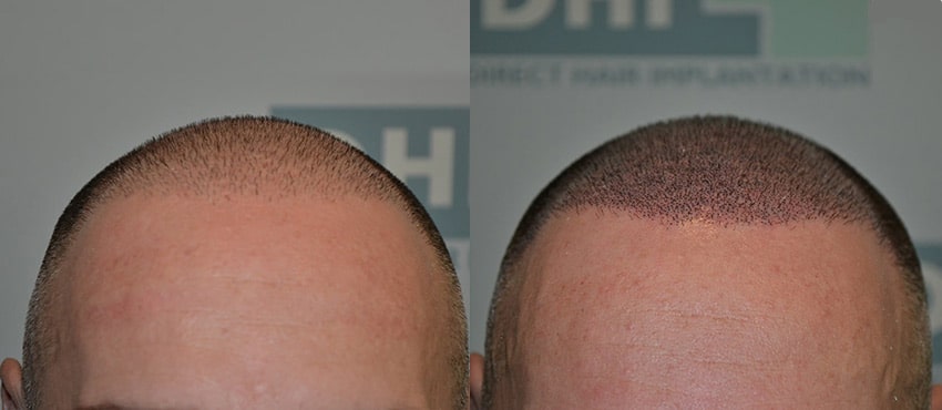 Hair transplant Results, Hair Transplant Before and After - DHI