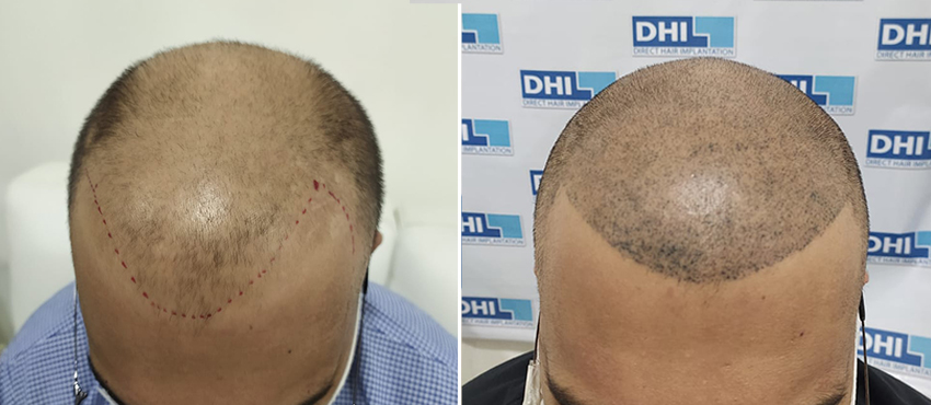 scalp hair transplant results