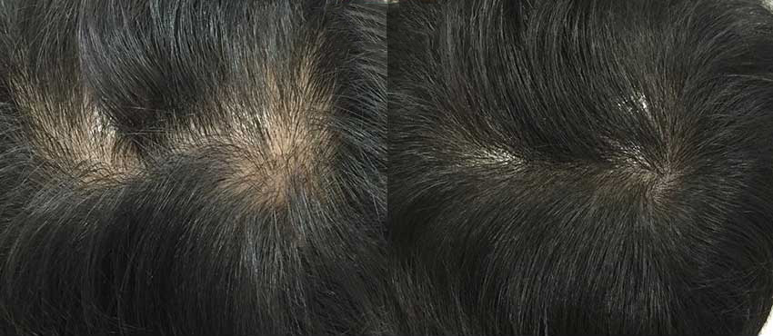  scalp hair transplant results 