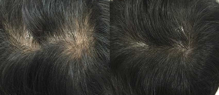  scalp hair transplant results
                                         