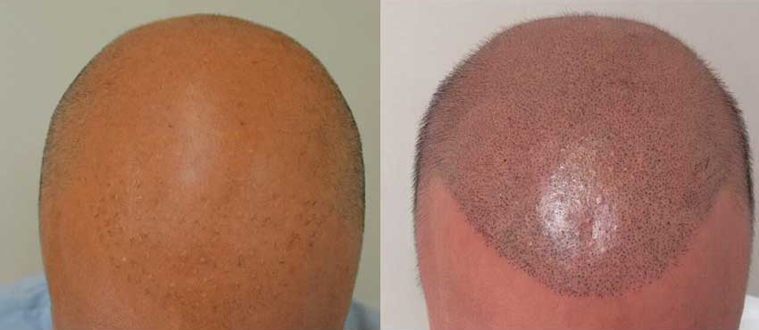 scalp hair transplant results