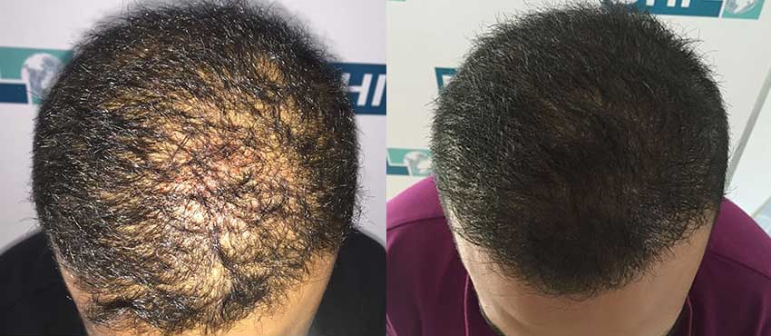  scalp hair transplant results