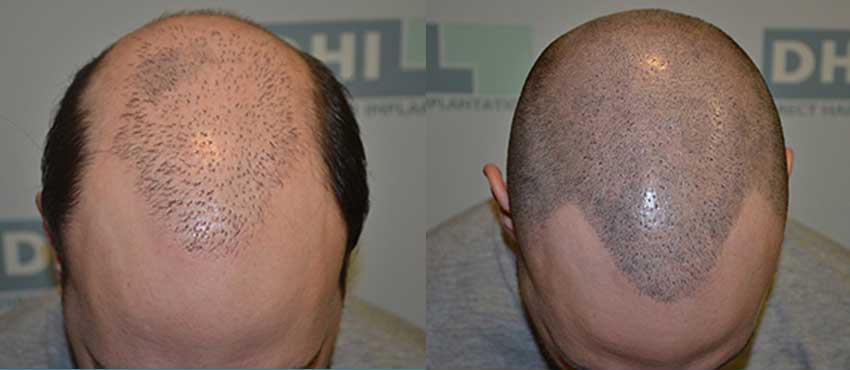  scalp hair transplant results
                                         