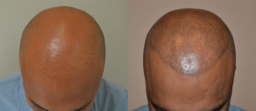 scalp hair transplant results