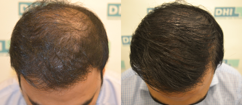 scalp hair transplant results