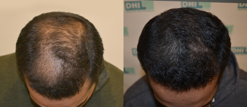  scalp hair transplant results
                                         