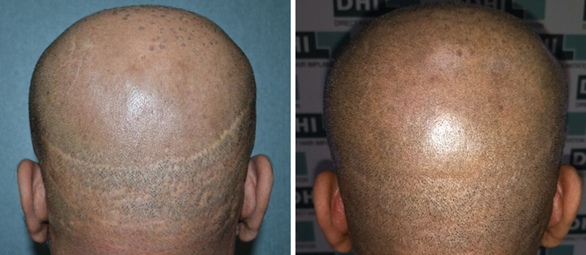 scalp hair transplant results