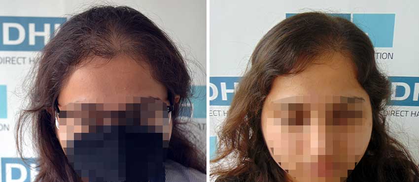 DHI before & after hair transplant results