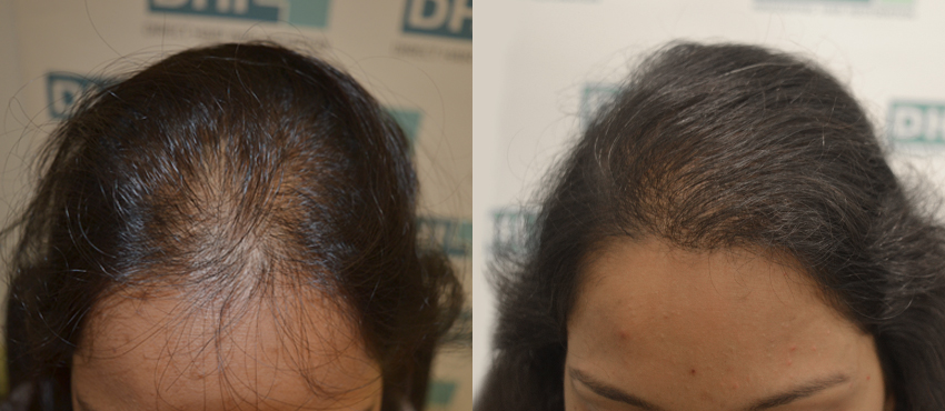 Hair Transplantation for Women  Female baldness treatment