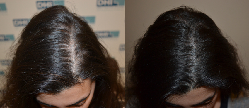 DHI before & after hair transplant results