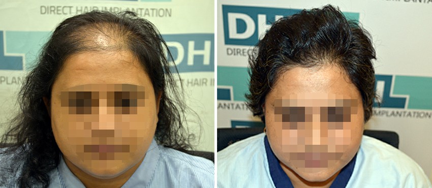 DHI before & after hair transplant results