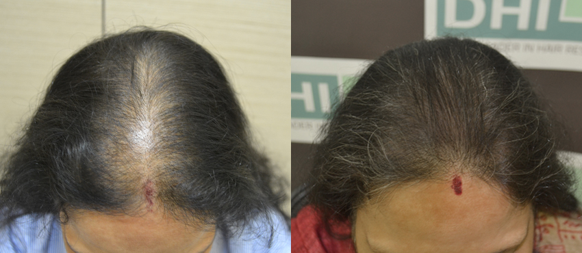 DHI before & after hair transplant results