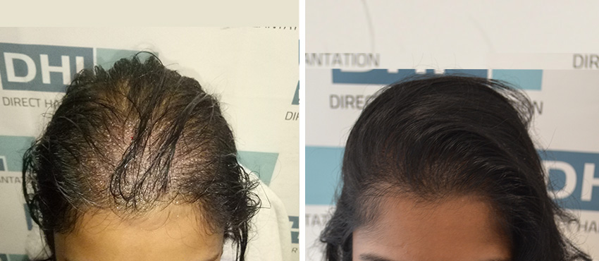 DHI before & after hair transplant results