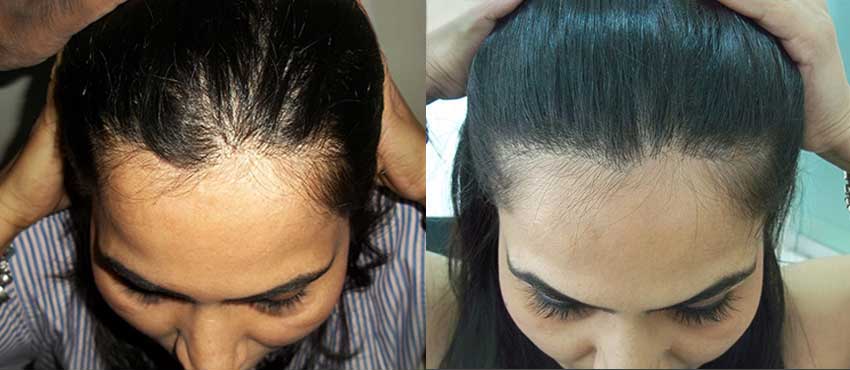 Hair transplant Results, Hair Transplant Before and After - DHI