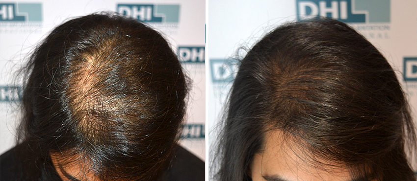 DHI before & after hair transplant results