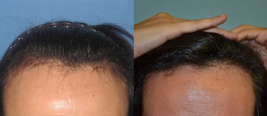 DHI before & after hair transplant results
                                         