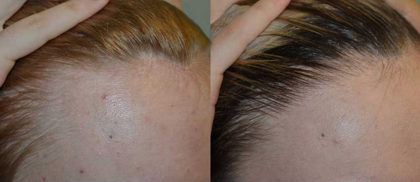 DHI before & after hair transplant results