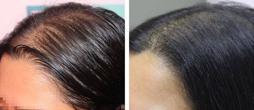 DHI before & after hair transplant results
                                         