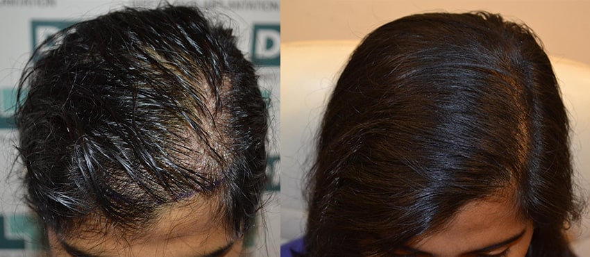 DHI before & after hair transplant results